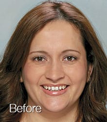 Claudia Lumineers before photo.