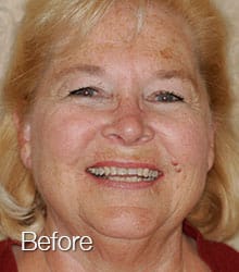 Grace Lumineers before photo.